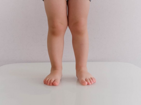Kind mit Beinfehlstellung