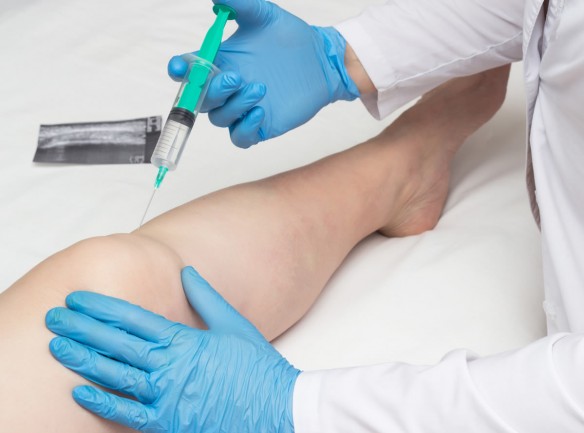 Infiltrationstherapie am Knie